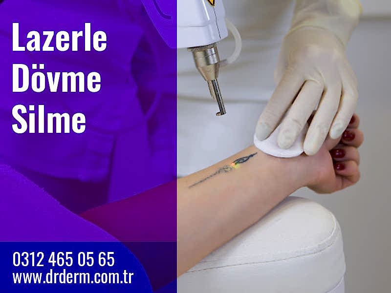 Lazerle Dövme Silme
