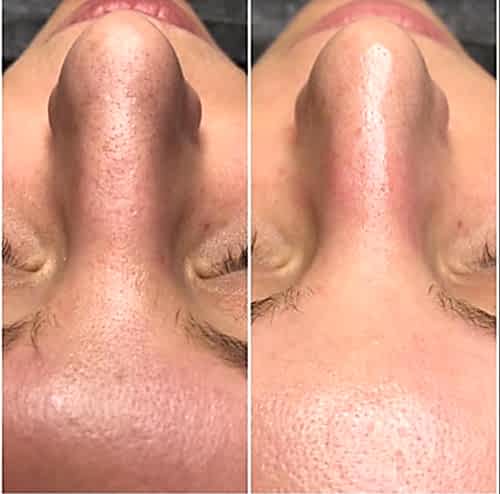 Hydrafacial